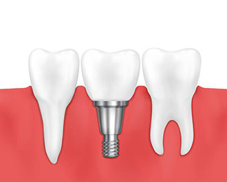 alanya-dental-implant