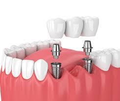 Alanya-Dental-implant